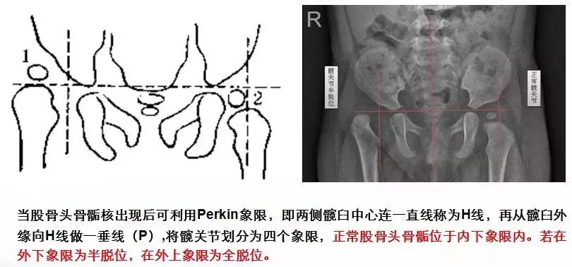 宝宝臀纹不对称妈妈不上心，长大后孩子走路一瘸一拐