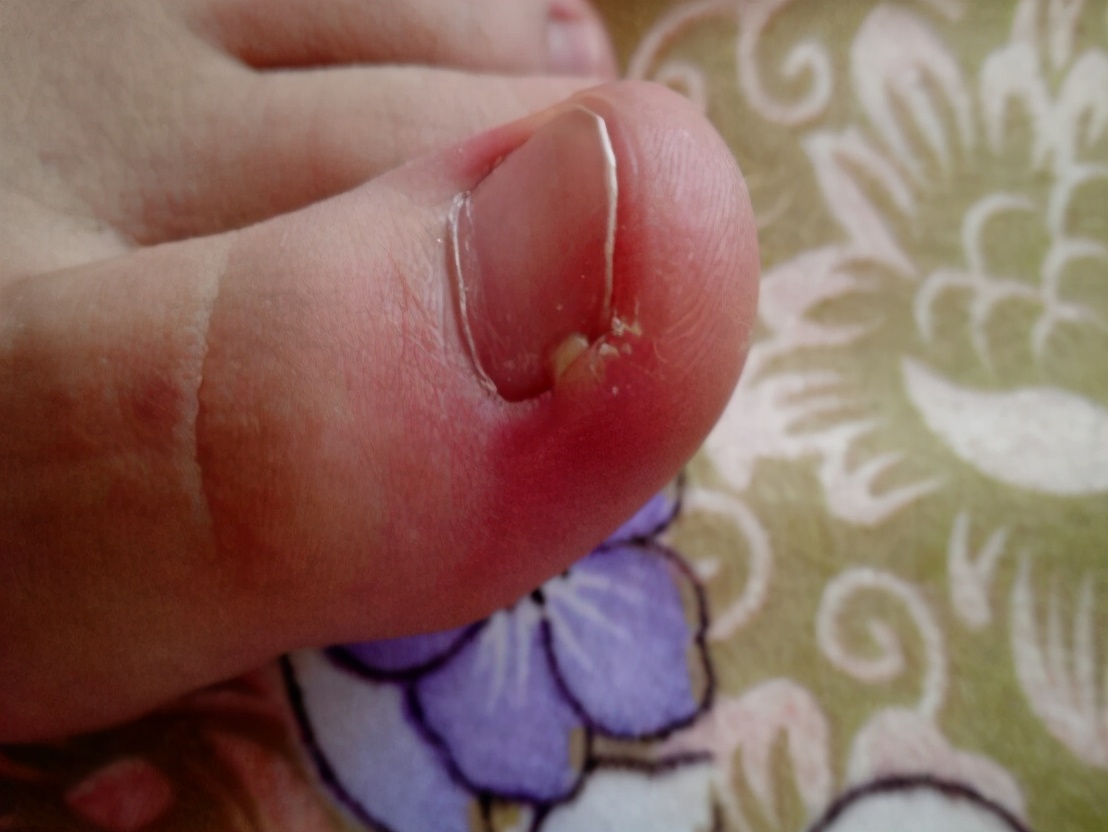 宝宝甲沟炎早期图片(造成甲沟炎的) - 赤虎壹号