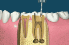 牙坏到什么程度要做根管治疗？为什么做完还要在花钱戴牙冠？