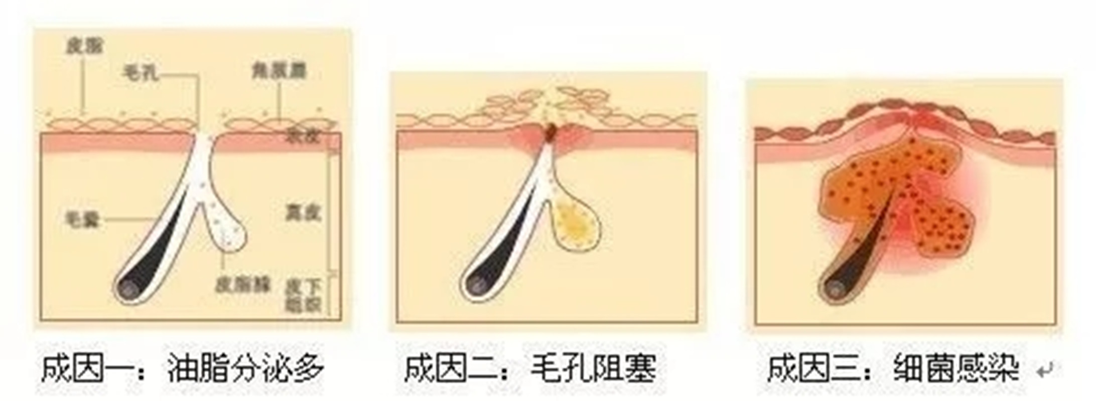 脸部老爱长痘怎么办？坚持做好这几个方法，还你干净的面容