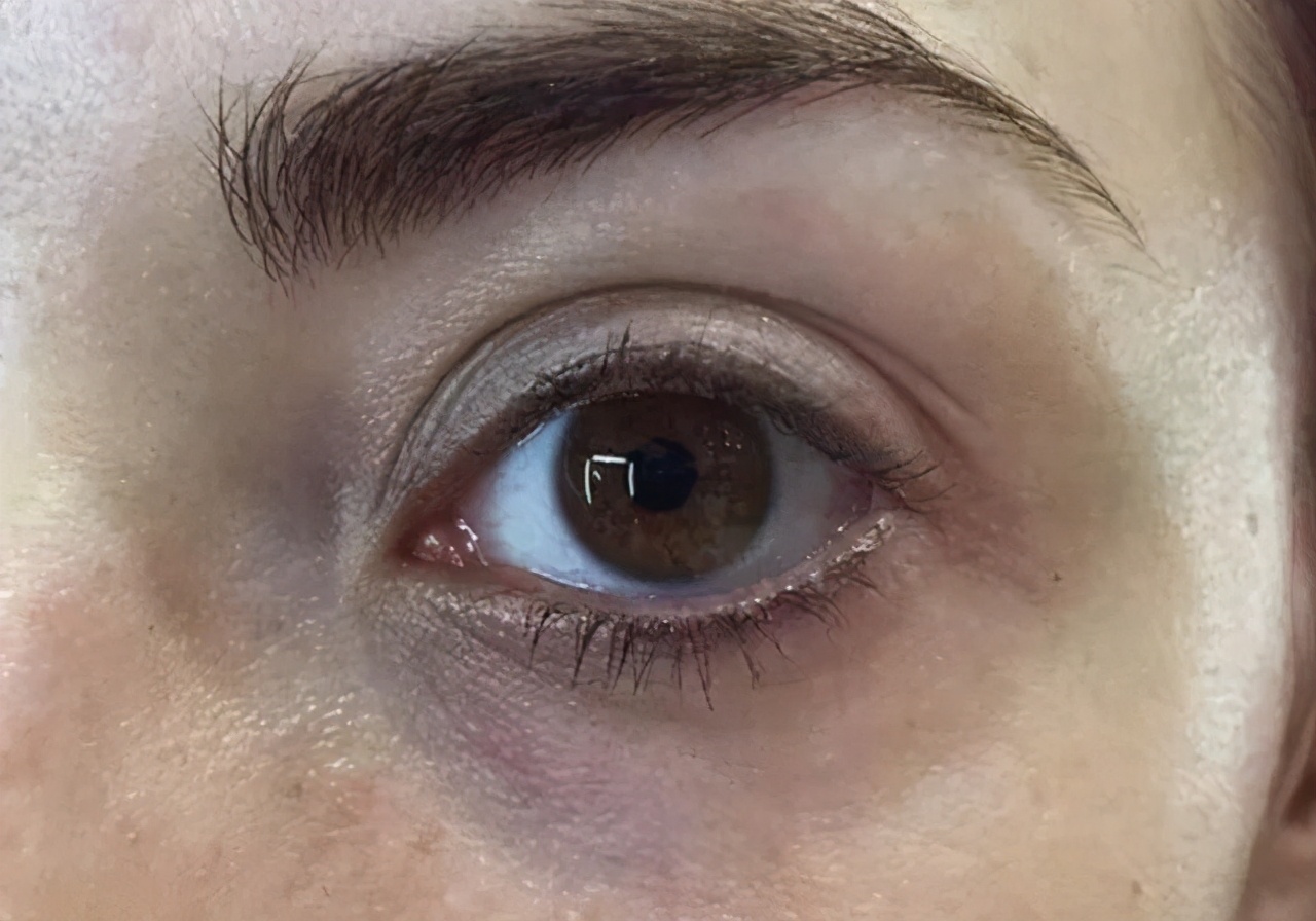 黑眼圈很严重怎么办?怎么拯救特别严重的黑眼圈?