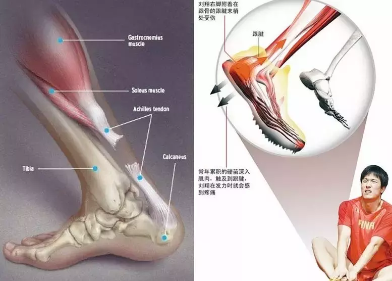 跟腱为什么会突然断裂(科普：什么是跟腱断裂？跟腱损伤怎么办？详解跟腱断裂病因及预防)