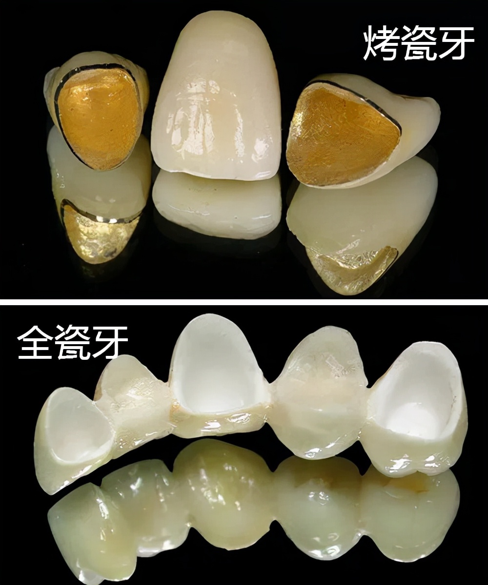 烤瓷牙虽好，也不要乱镶！使用烤瓷牙这几个禁忌必须了解清楚