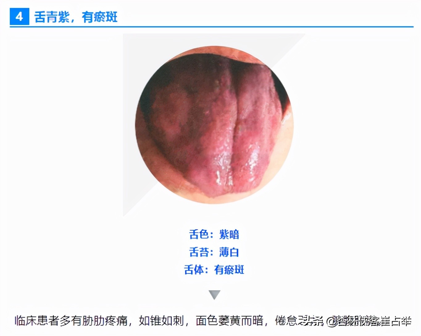 如何通过舌头，分辨心脑血管疾病、中风前兆？教你一招，快速辨别
