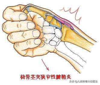 都是腱鞘炎，为啥我家宝宝是先天性的？家长想知道的都在这里