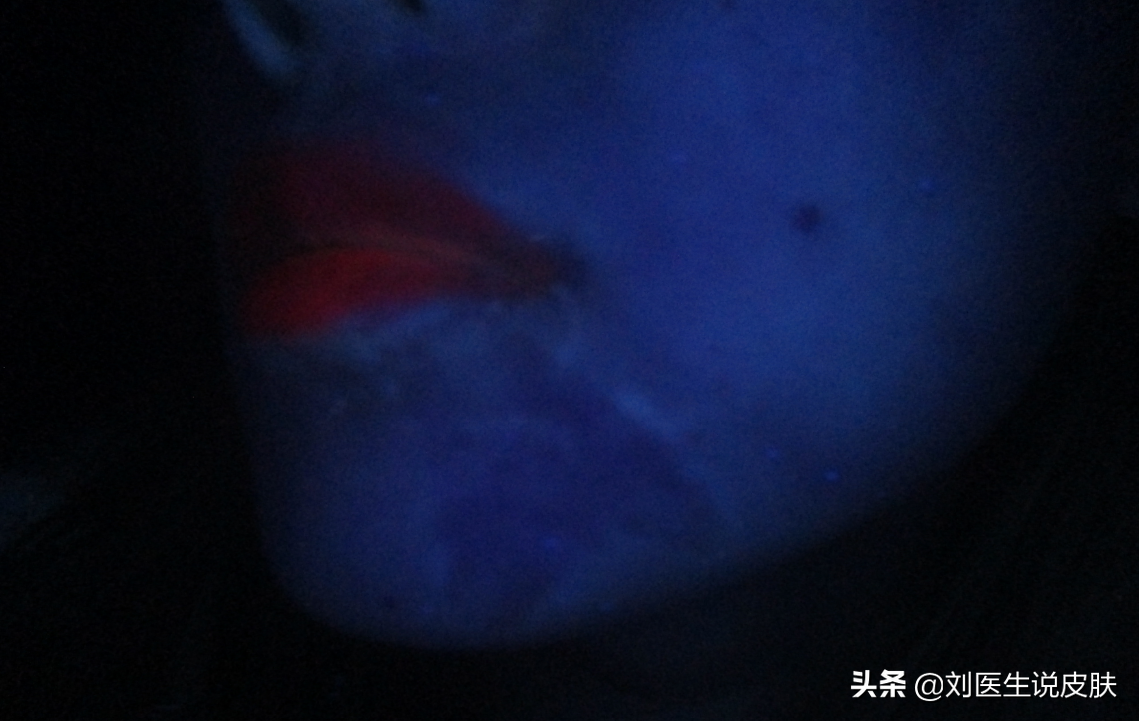 20岁女子患白癜风后，牢记医生说的这3个原则，然后白斑就没了