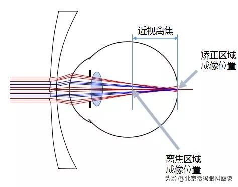 这四大青少年近视防控“神器”，你更“青睐”谁？