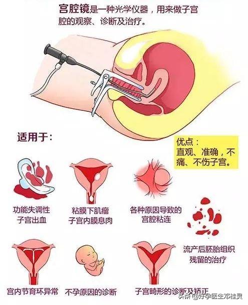 备孕科普：为什么很多医生会建议不孕的你做宫腹腔镜联合手术？