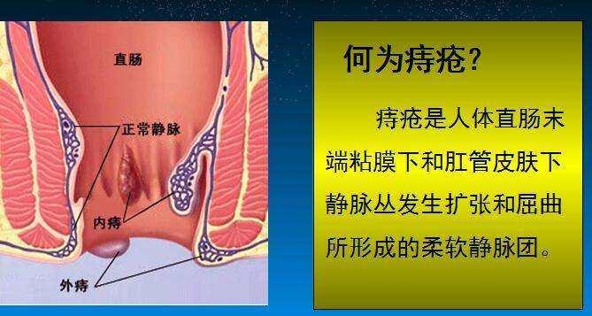 什么痔疮需要手术？有哪些治疗手段？一次性全都告诉你