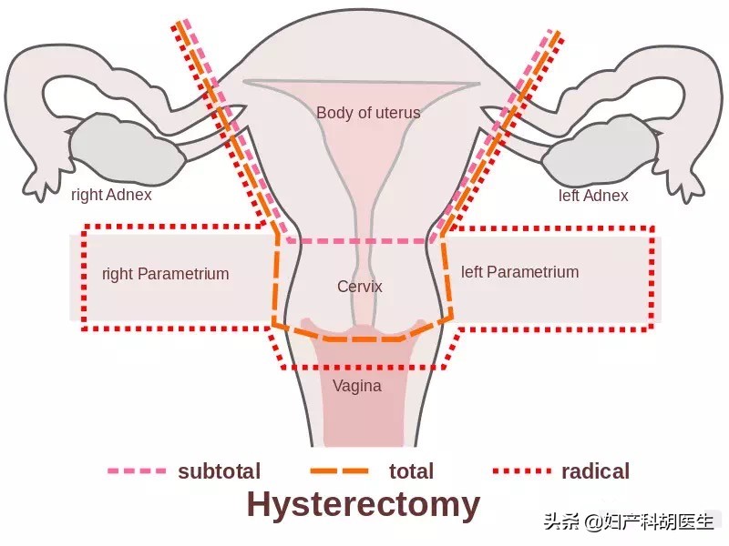 辟谣：切除子宫对女人会有哪些影响？