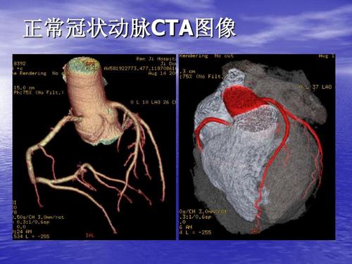 查冠心病不必做造影！更便宜、更有效的检查门诊就能做！值得收藏