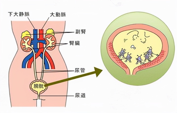 慢性膀胱炎的主要症状以及日常护理