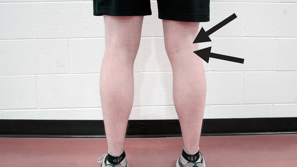 腘窝囊肿:为什么说它是骨科医生的滑铁卢?