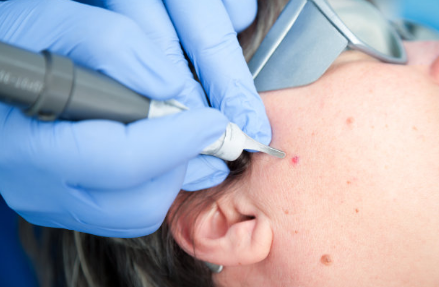 1,血管痣(樱桃样血管瘤)