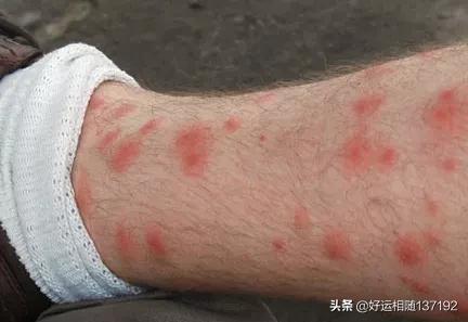 被臭虫咬过后浑身奇痒起血包的亲身感受，你见过咬人的臭虫吗？