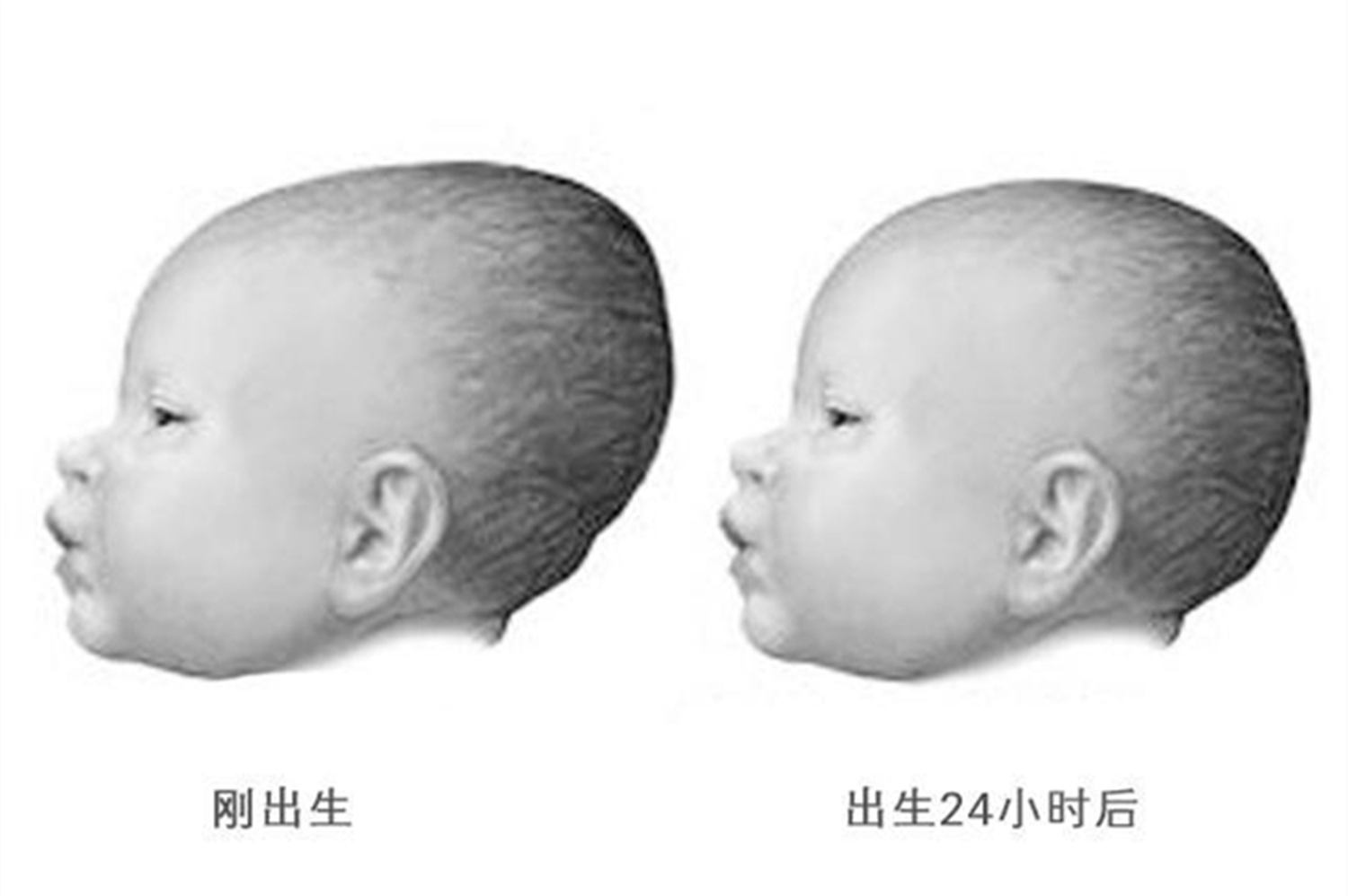 颅骨锁骨发育不全 1 例及基因检测分析