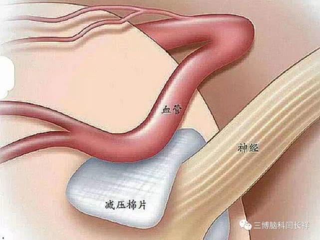 厦门一男子拔牙6颗，牙痛依旧，一查竟是“天下第一痛”惹的祸