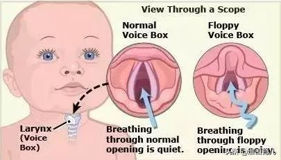 新生儿嗓子里呼噜呼噜像是有痰怎么办？可能是因为下面几种情况