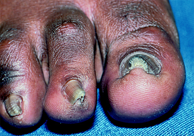 脚趾甲老往肉里长,得了「嵌甲」怎么办?医生:你需要知道这3点