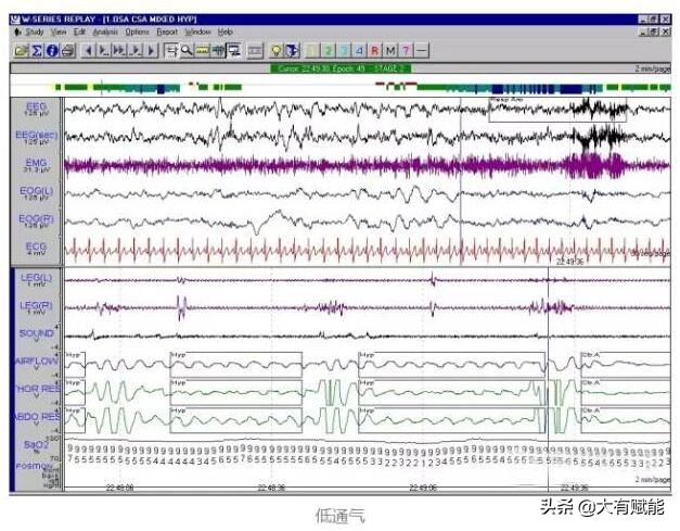 全面解析睡眠呼吸暂停