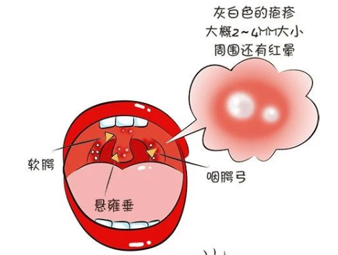 皰疹性咽峽炎高發季節,6歲兒子中招了,照護經驗給你,早預防