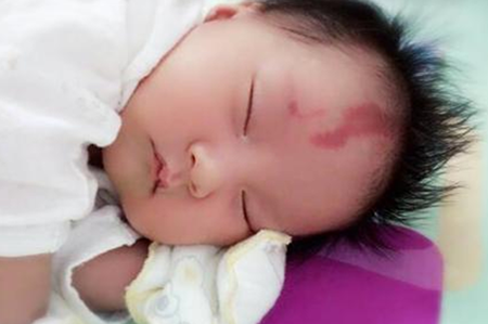 胎记是怎么来的？产科医生：孕期避开这3种行为，以免伤害到胎儿