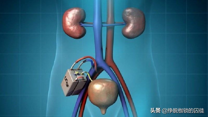 万众瞩目的可植入人体内的生物人工肾脏明年有希望吗？