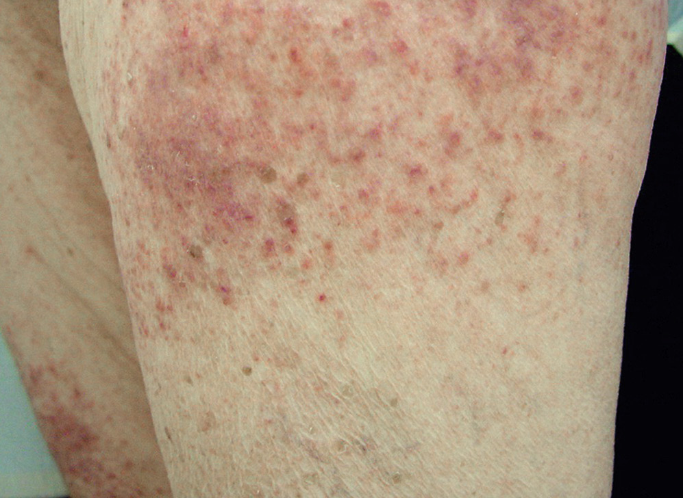 皮肌炎有什么样的皮肤改变?(1)