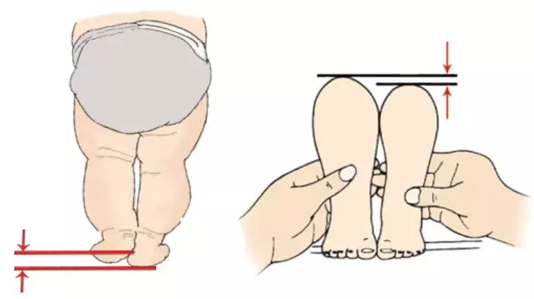 宝宝臀纹不对称妈妈不上心，长大后孩子走路一瘸一拐