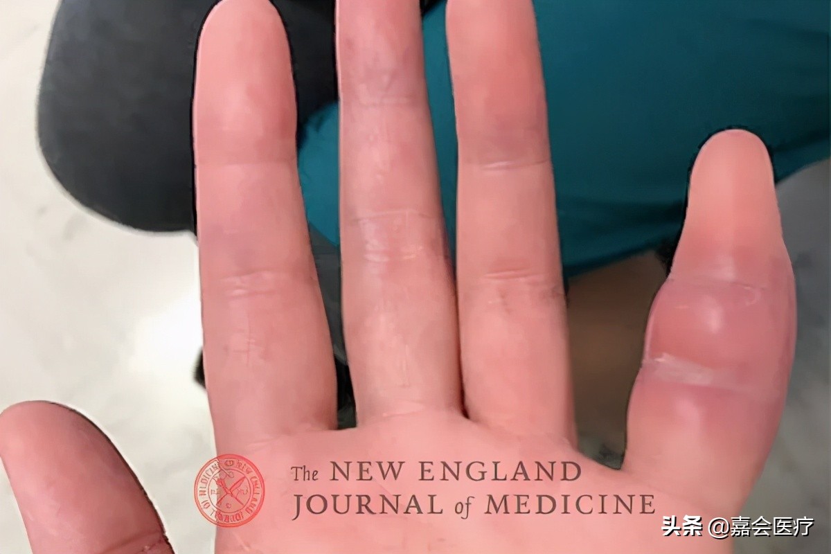 手指肿胀疼痛，真实病因原来在肺里，医生都觉得罕见