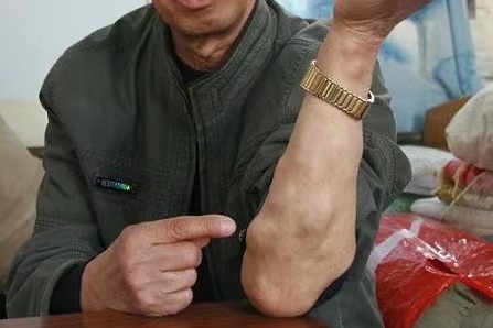 胸部长痘与身上频发脂肪瘤的原因解析