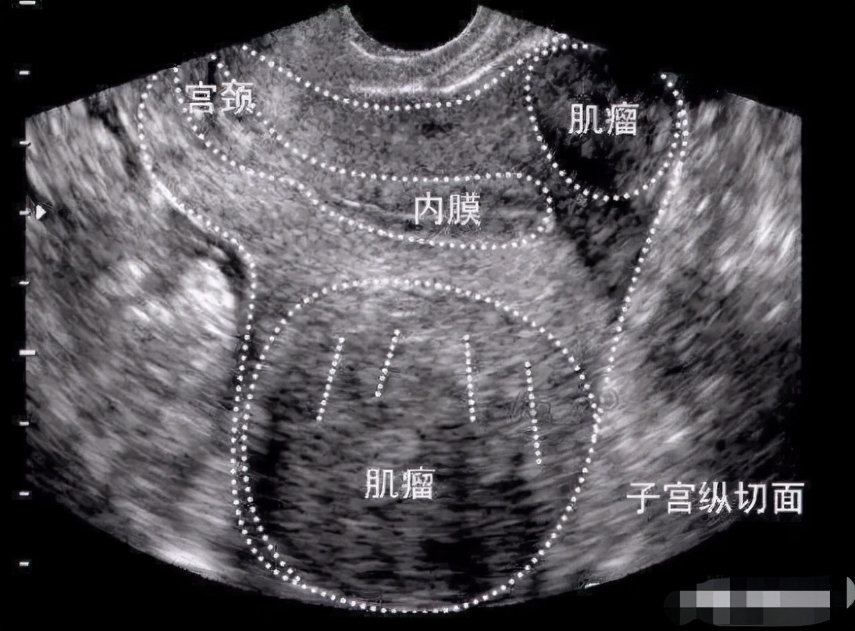 女性为什么容易长子宫肌瘤？医生提醒：这3个因素要注意