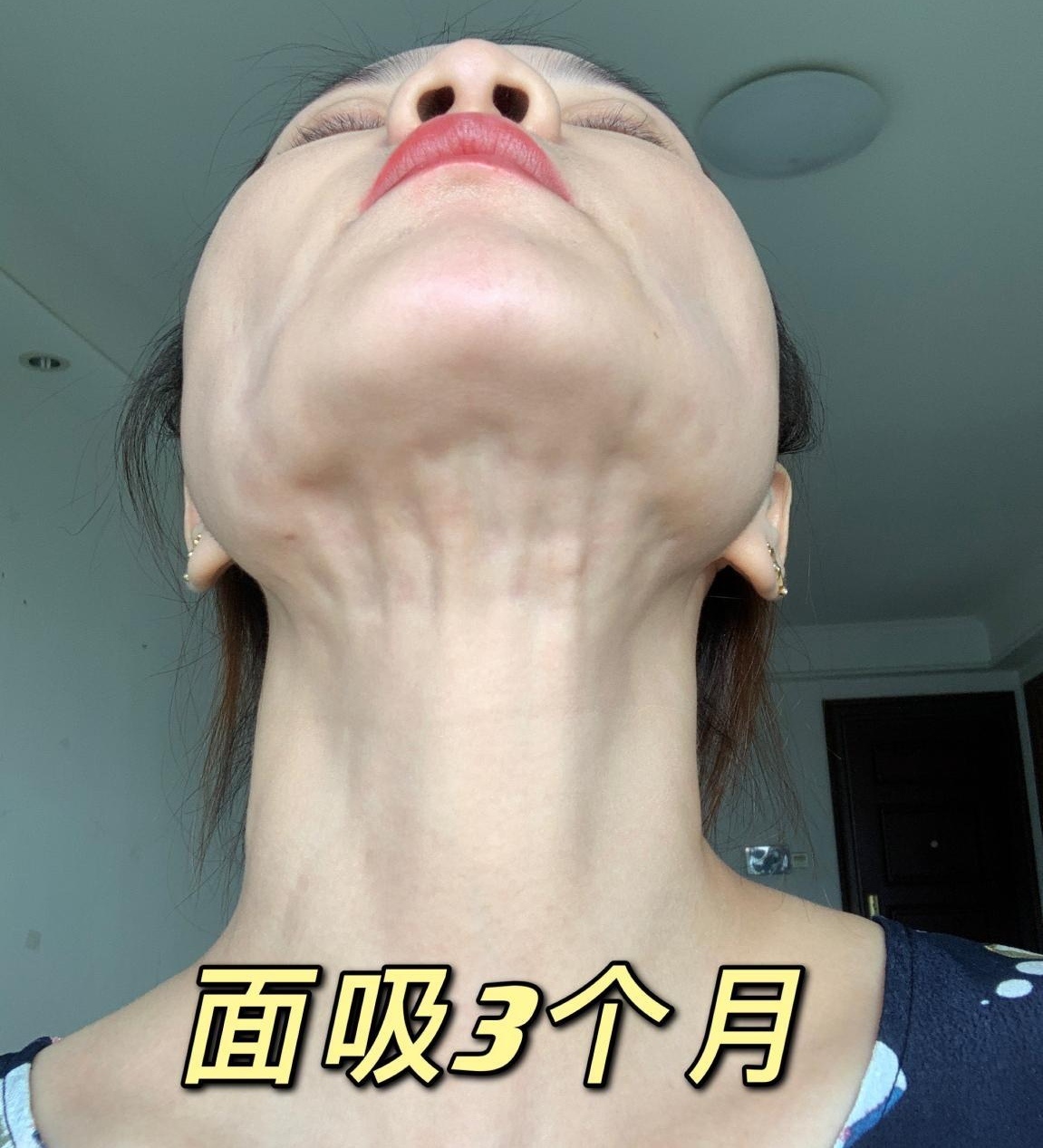 女子面部吸脂导致容貌被毁?医美机构面对索赔反称被敲诈