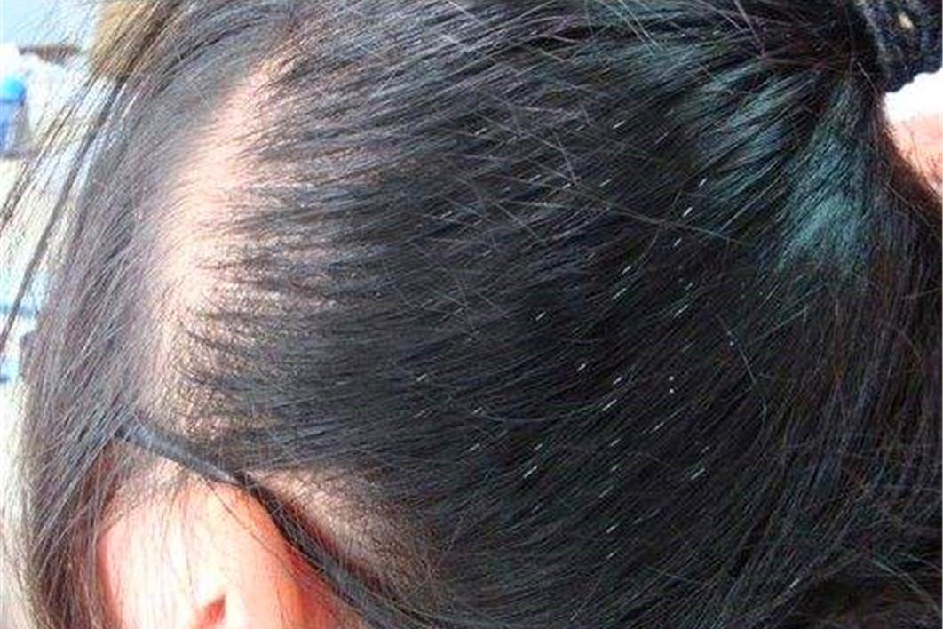 同人类共进化，30年前农村人人都长的虱子，为何如今看不到了？
