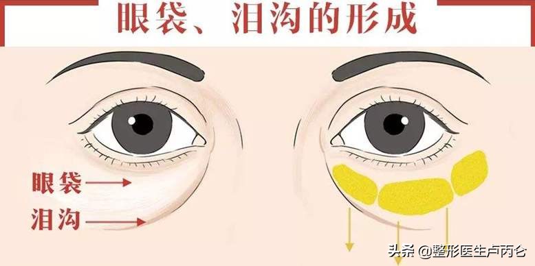 下眼皮松弛皱纹怎么处理？皮肤松弛可考虑眼袋手术改善