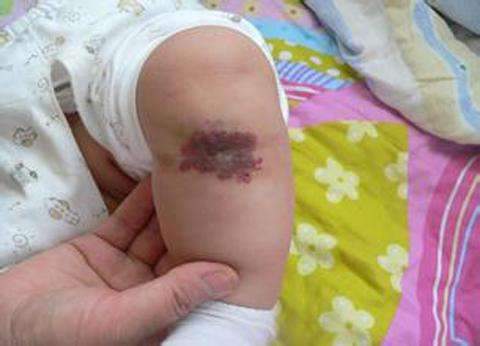 1,网格状胎记这种胎记称为网状青斑,是由局部血管收缩能力异常引发