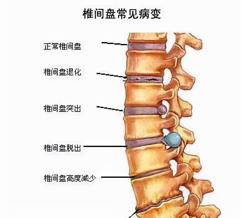 年紀輕輕就腰椎間盤突出了？ 早期出現這幾種症狀要留意，積極治療