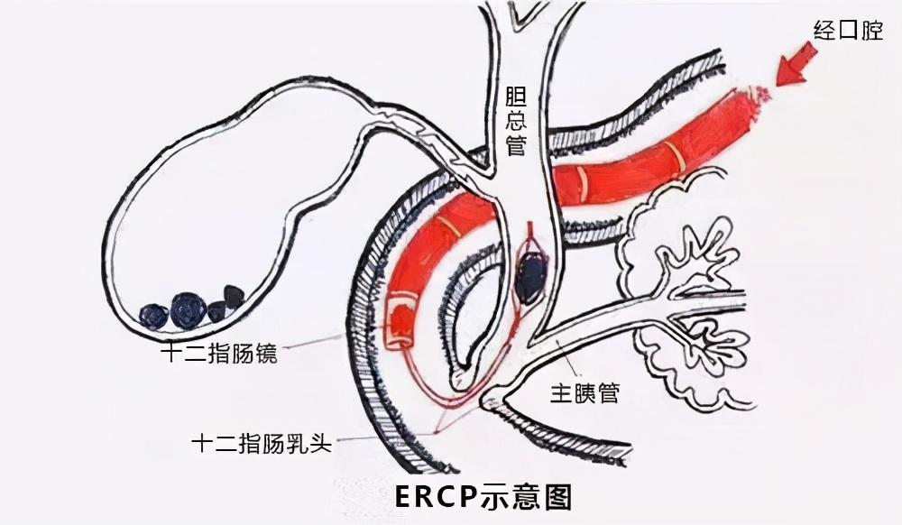 谁说结石手术就一定要开刀？认识两种不开刀的结石微创手术