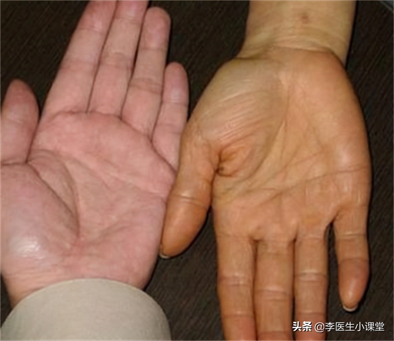 二,胆红素稍高有什么症状?