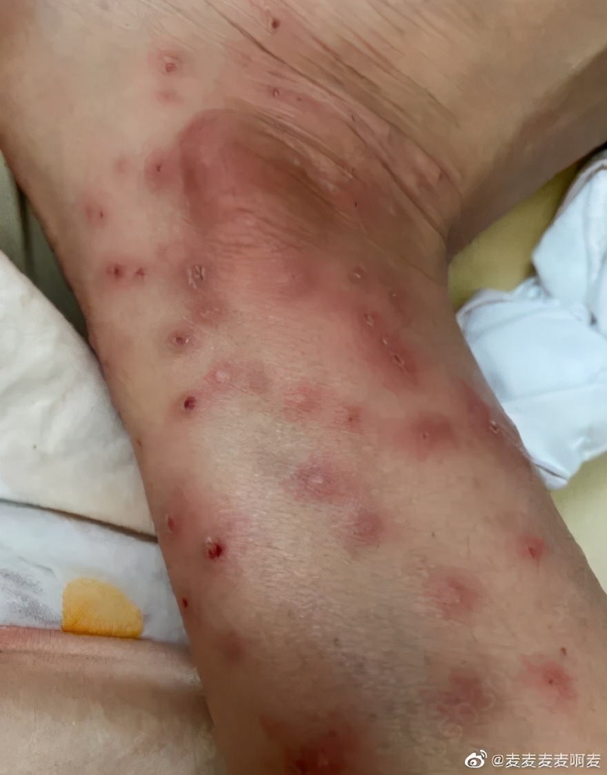 红火蚁攻击性很强,一些体质敏感的人被它叮咬后,可能会发生过敏性休克