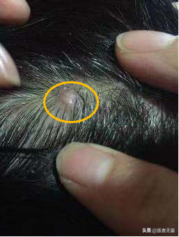 毛囊炎的成因分析：似疖非疖的皮肤感染原因探讨