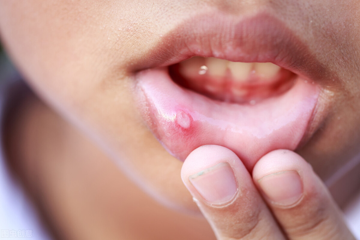 烂嘴角怎么办最快最有效的方法，好得快治疗的办法详解？