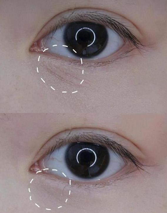 国外一女子花钱割了眼袋,如今"闭眼困难",其实变美不用这么麻烦