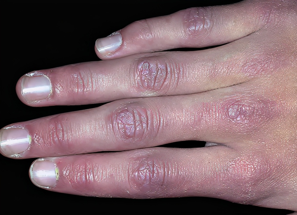 皮肌炎有什么样的皮肤改变?(1)