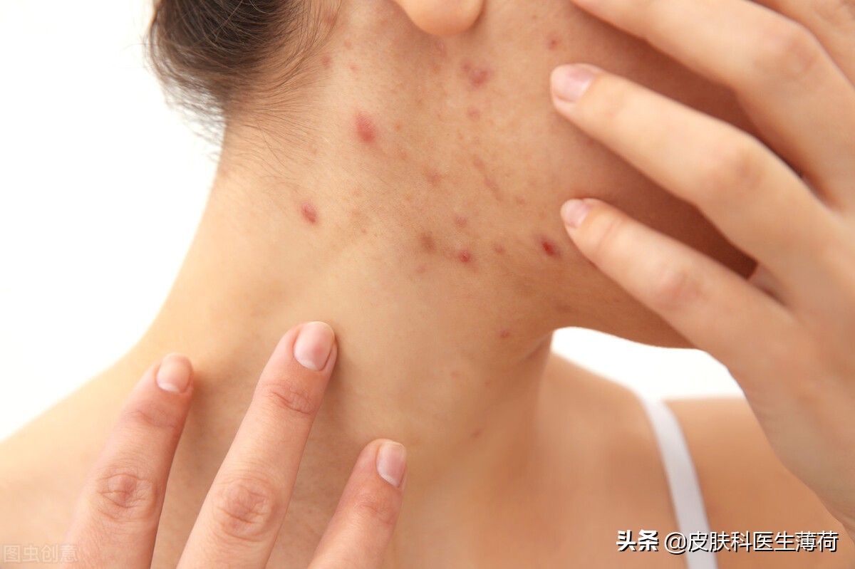 皮肤科医生指导：有效淡化痘痘黑印的方法与技巧