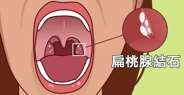 咽部有异物感,用力一咳,咳出很臭的"小石头"?经历过的看过来