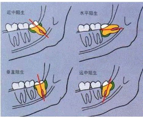 一次拔两颗智齿后悔死了(折磨了我近两年的智齿终于拔掉了)