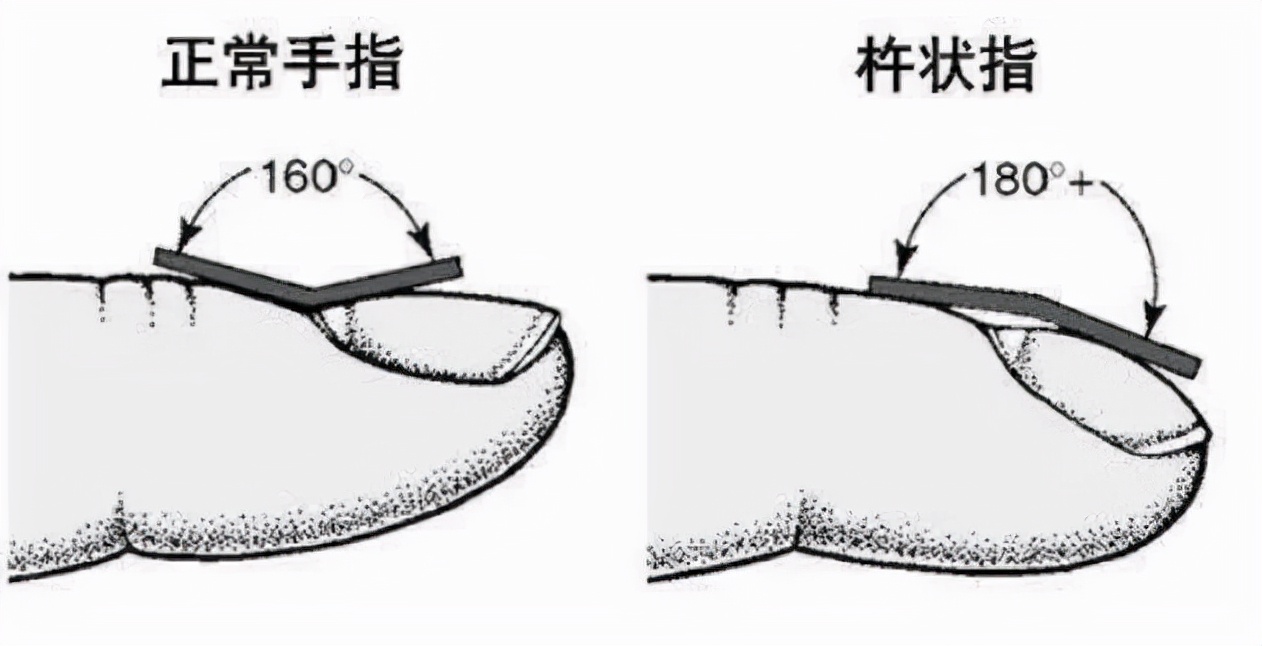 指甲长这样，是癌症的信号？别不信！出现这些"异样"可能已是大病