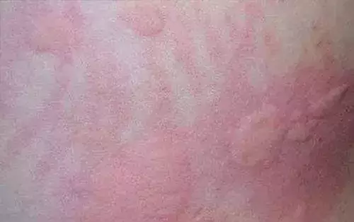 妈妈泣诉：我的错误做法，让娃受尽折磨。如何正确应对荨麻疹？