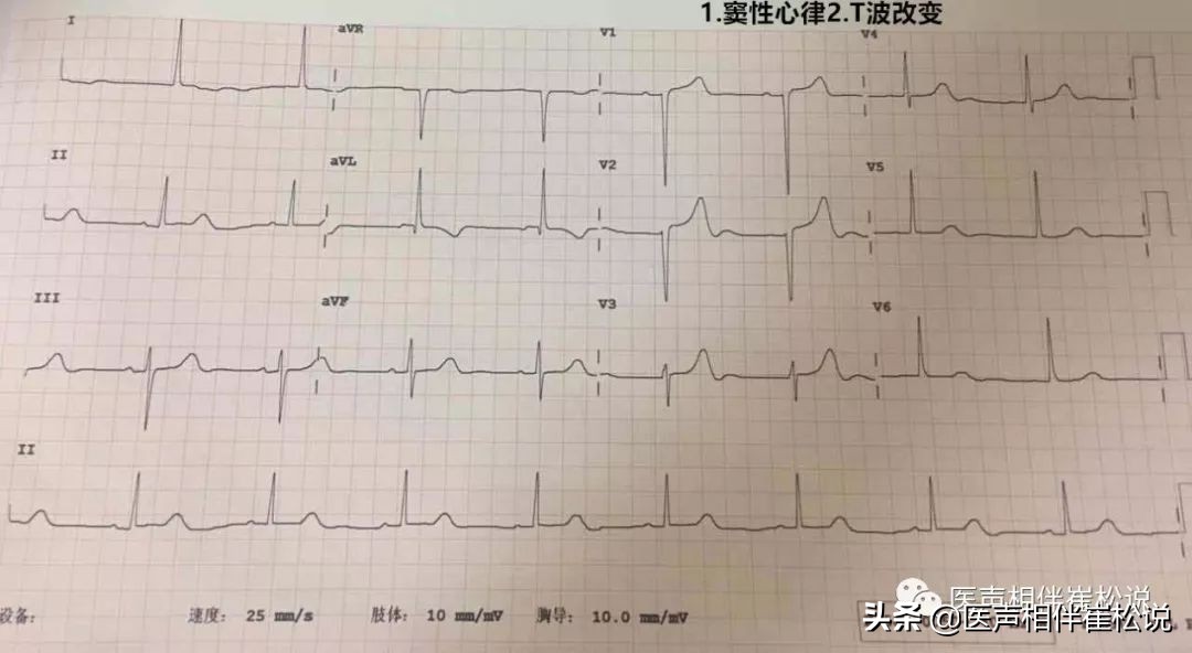 心电图上的T波改变严重吗？！是不是心肌缺血？！